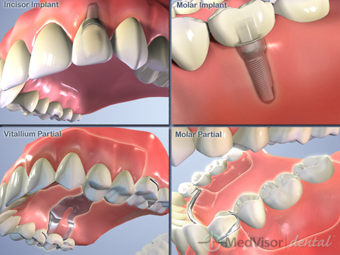 インプラント 入れ歯との比較